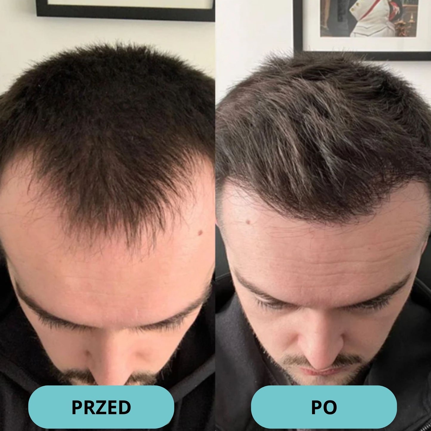Bodywise Serum na porost włosów